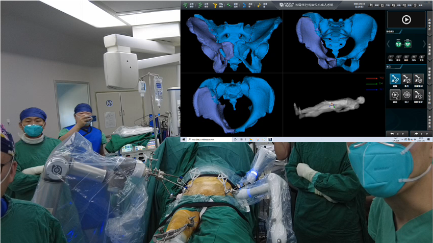 羅森博特| 智能化手術(shù)機(jī)器人成功治療92歲高齡骨盆骨折患者
